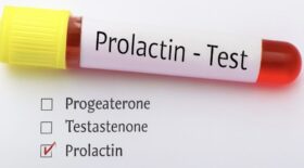 Wie erkennt man einen zu hohen Prolaktinspiegel? Was sind typische Symptome – und welche Behandlungen helfen bei Hyperprolaktinämie?