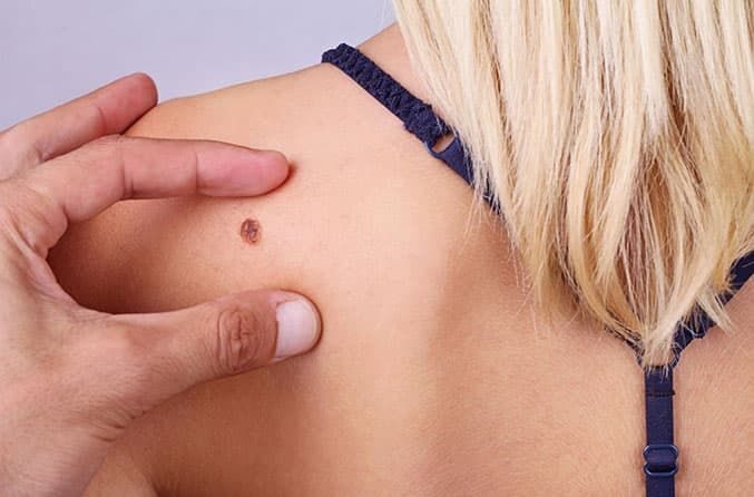 Leberflecke verstehen: Erfahre, welche 5 Faktoren – von Genetik bis zu Sonnenstrahlen – für die